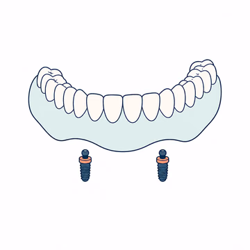 Editorial illustration of an implant-retained lower denture