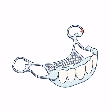 Editorial illustration of a partial denture and metal framework
